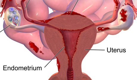 子宫内膜异位性不孕