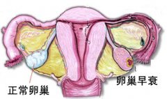心理压力大会导致卵巢早衰吗